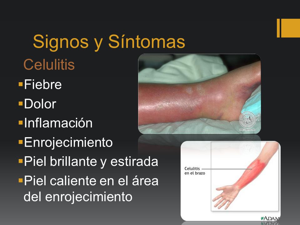 Celulitis inflamacion en la cara